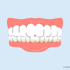 does teeth whitening remove plaque 