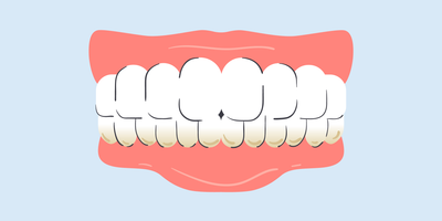 does teeth whitening remove plaque 
