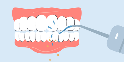 does water flosser remove plaque