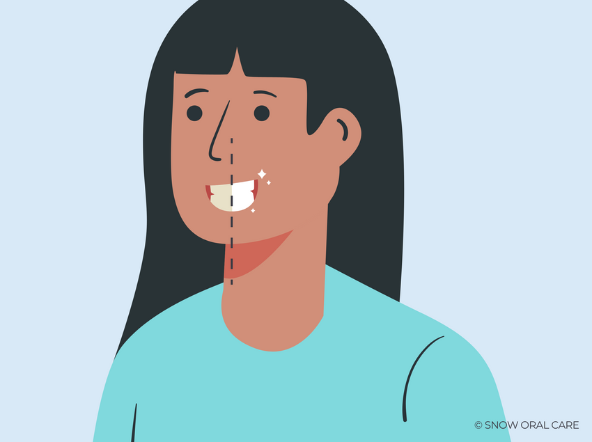how long are teeth porous after whitening 