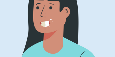 how long are teeth porous after whitening 
