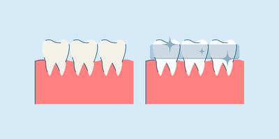 how long do teeth whitening strips take to work