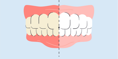 how long will my gums stay white after teeth whitening 