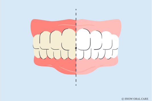 how long will my gums stay white after teeth whitening 