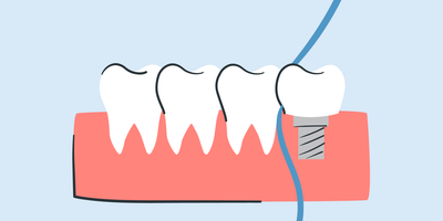 how to floss dental implants