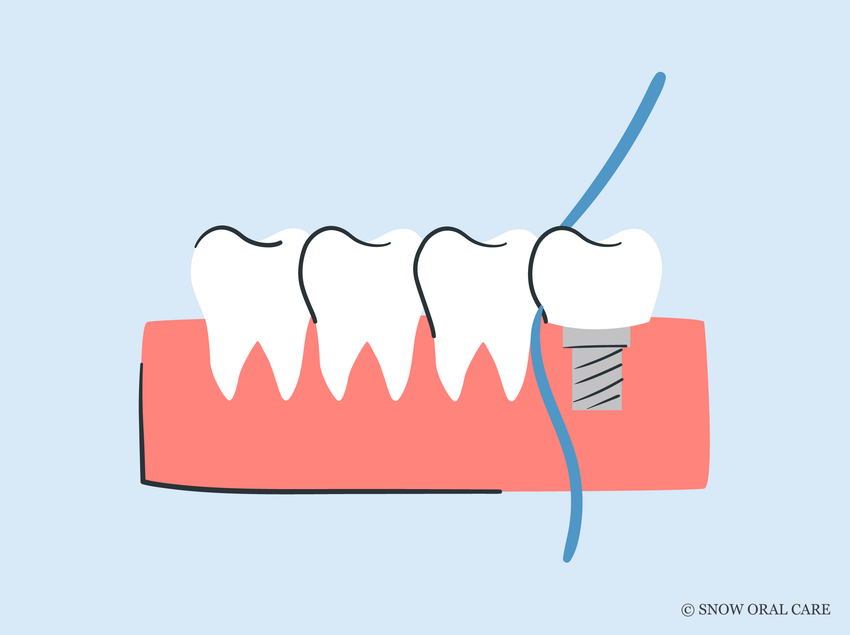 how to floss dental implants