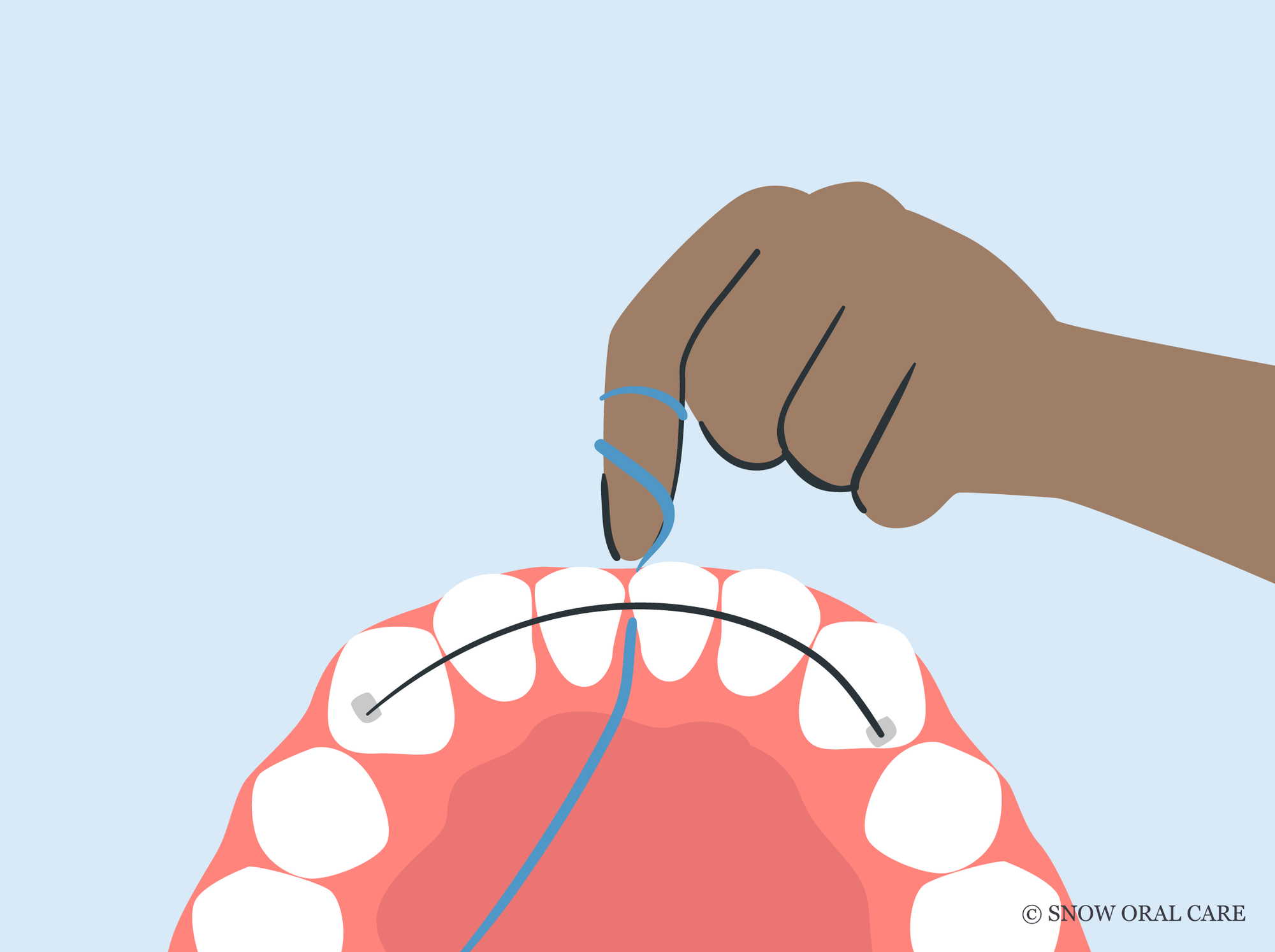 how to floss with permanent retainer