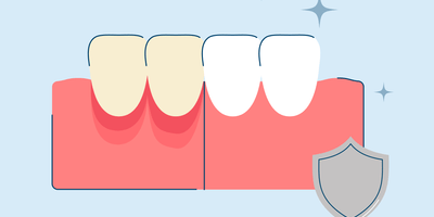 How to Protect Gums During Teeth Whitening