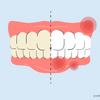 how to treat burned gums from teeth whitening 