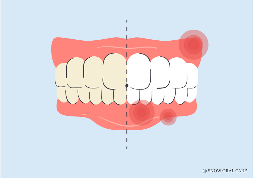 how to treat burned gums from teeth whitening 