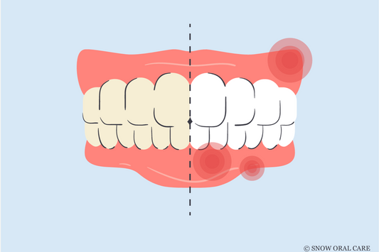 how to treat burned gums from teeth whitening 