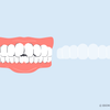 how to whiten bonded teeth 