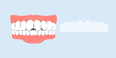 how to whiten bonded teeth 
