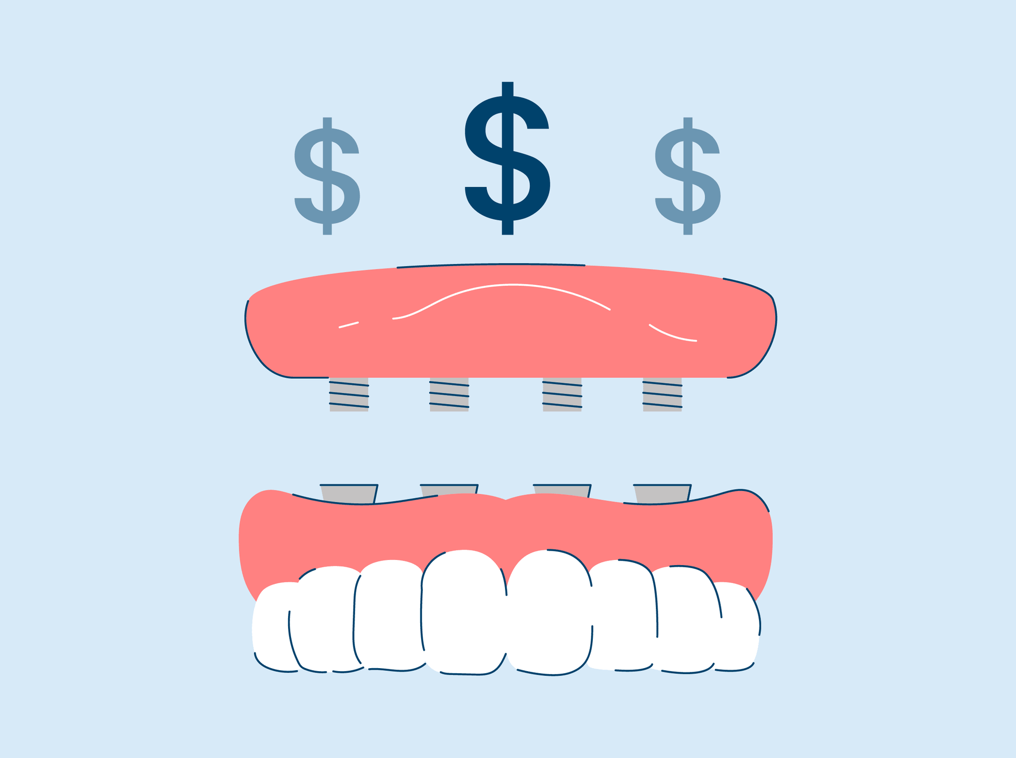 Hybrid Denture Cost, Pros, and Cons