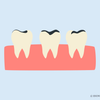 i want to whiten my teeth but i have fillings 