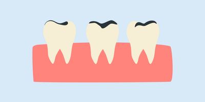 i want to whiten my teeth but i have fillings 