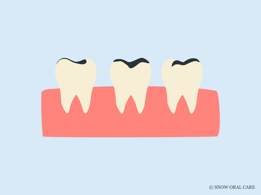 i want to whiten my teeth but i have fillings 