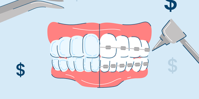 Invisalign vs. Braces: Cost & Procedure