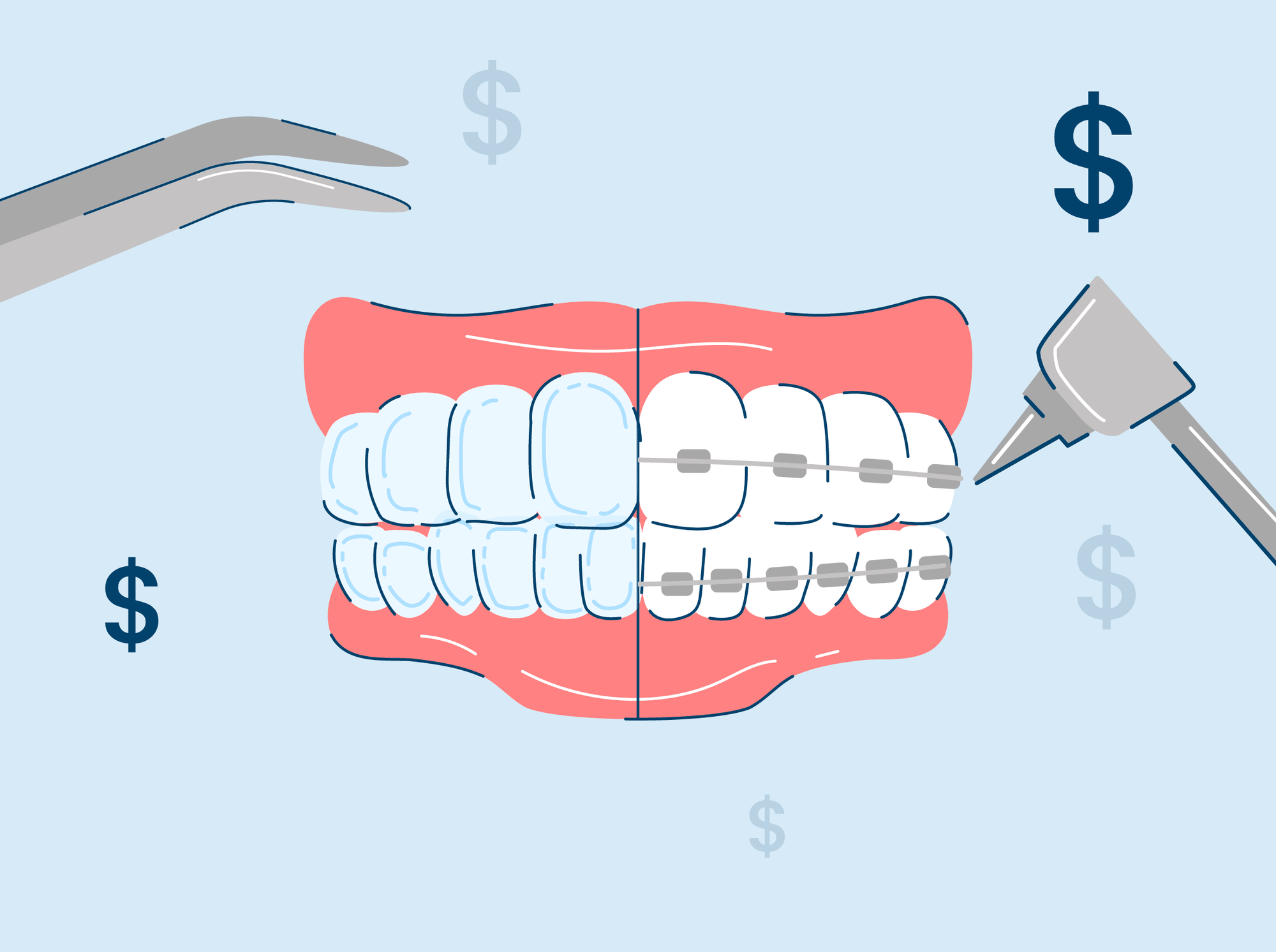 Invisalign vs. Braces: Cost & Procedure