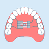 Palate Expanders: Types, Uses, Adjusting, and Care