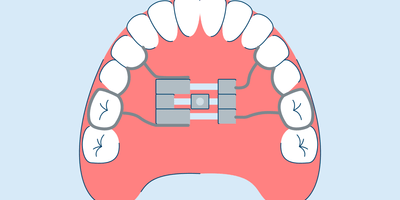 Palate Expanders: Types, Uses, Adjusting, and Care