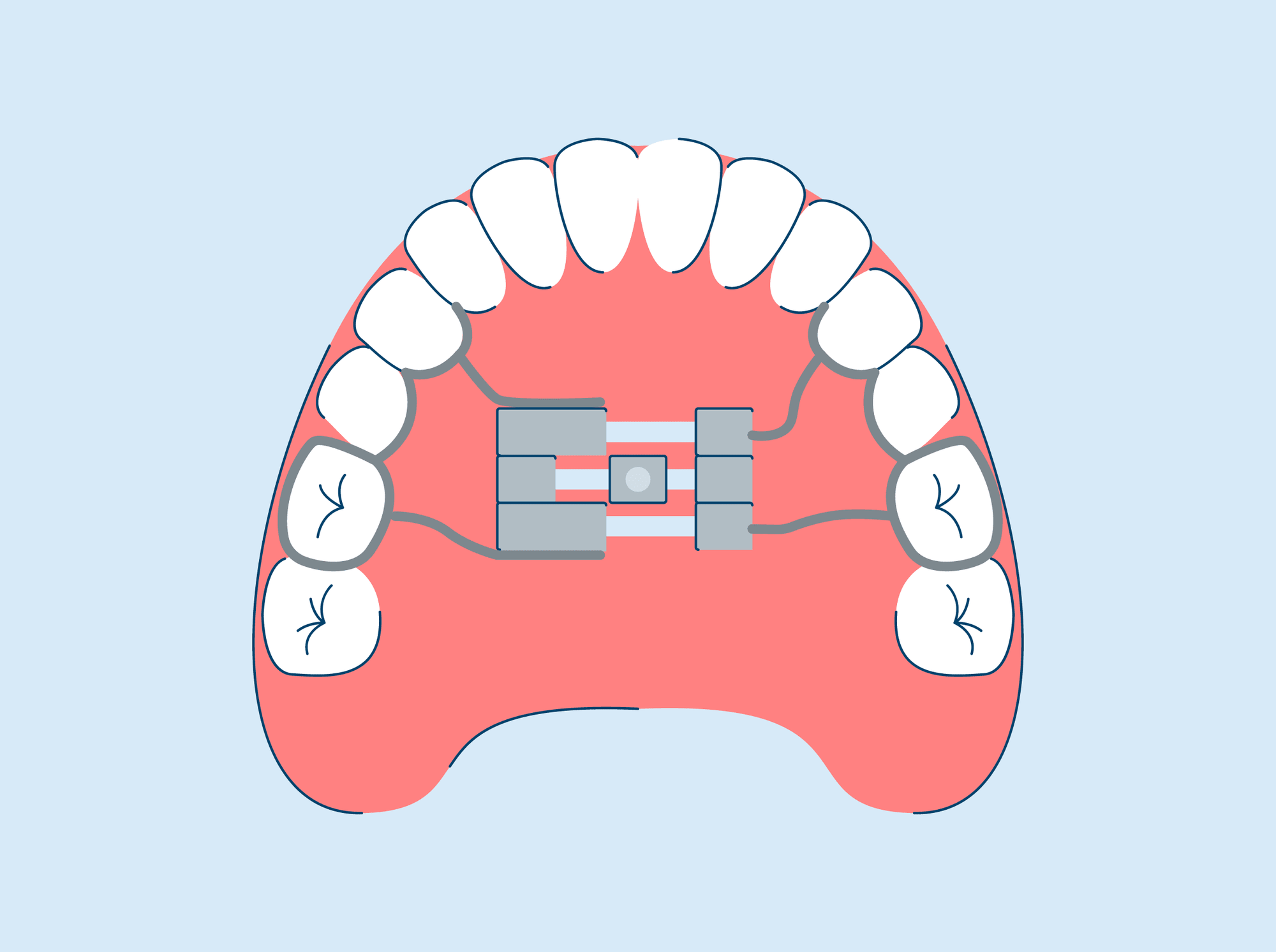 Palate Expanders: Types, Uses, Adjusting, and Care