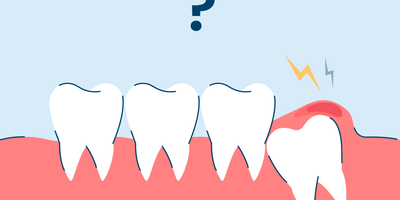 Pericoronitis: Symptoms and Treatment