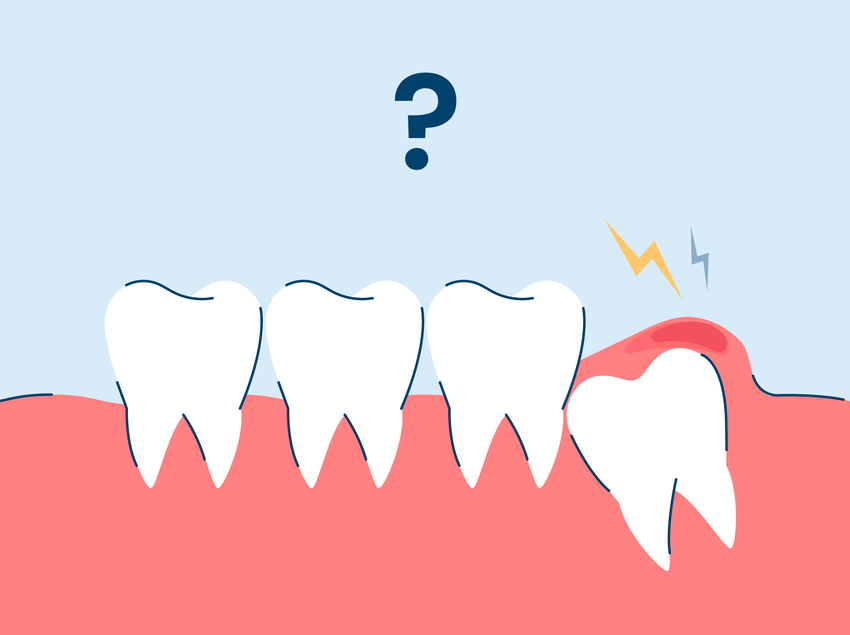 Pericoronitis: Symptoms and Treatment