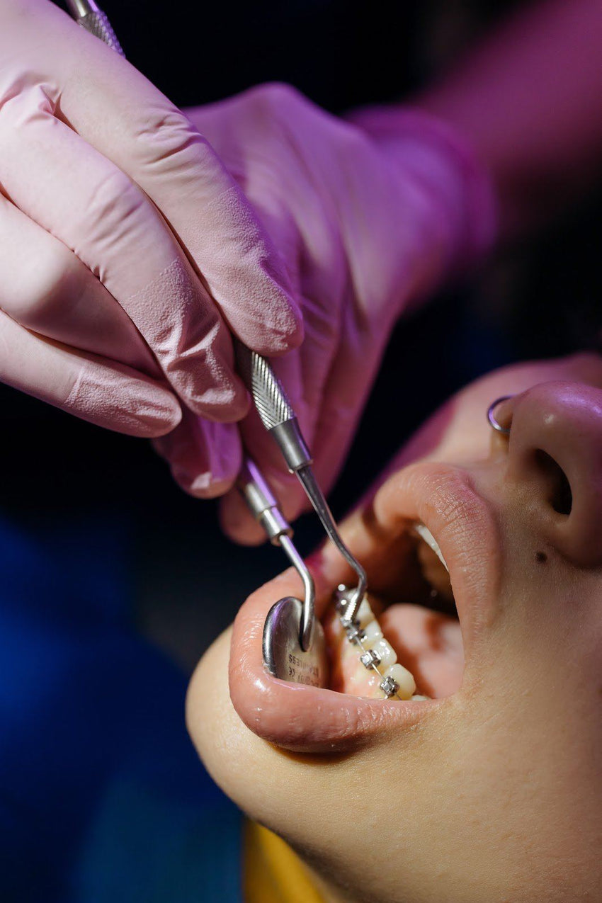 How to Get Whiter Teeth With Braces