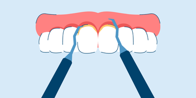 Scaling and Root Planing for Gum Disease