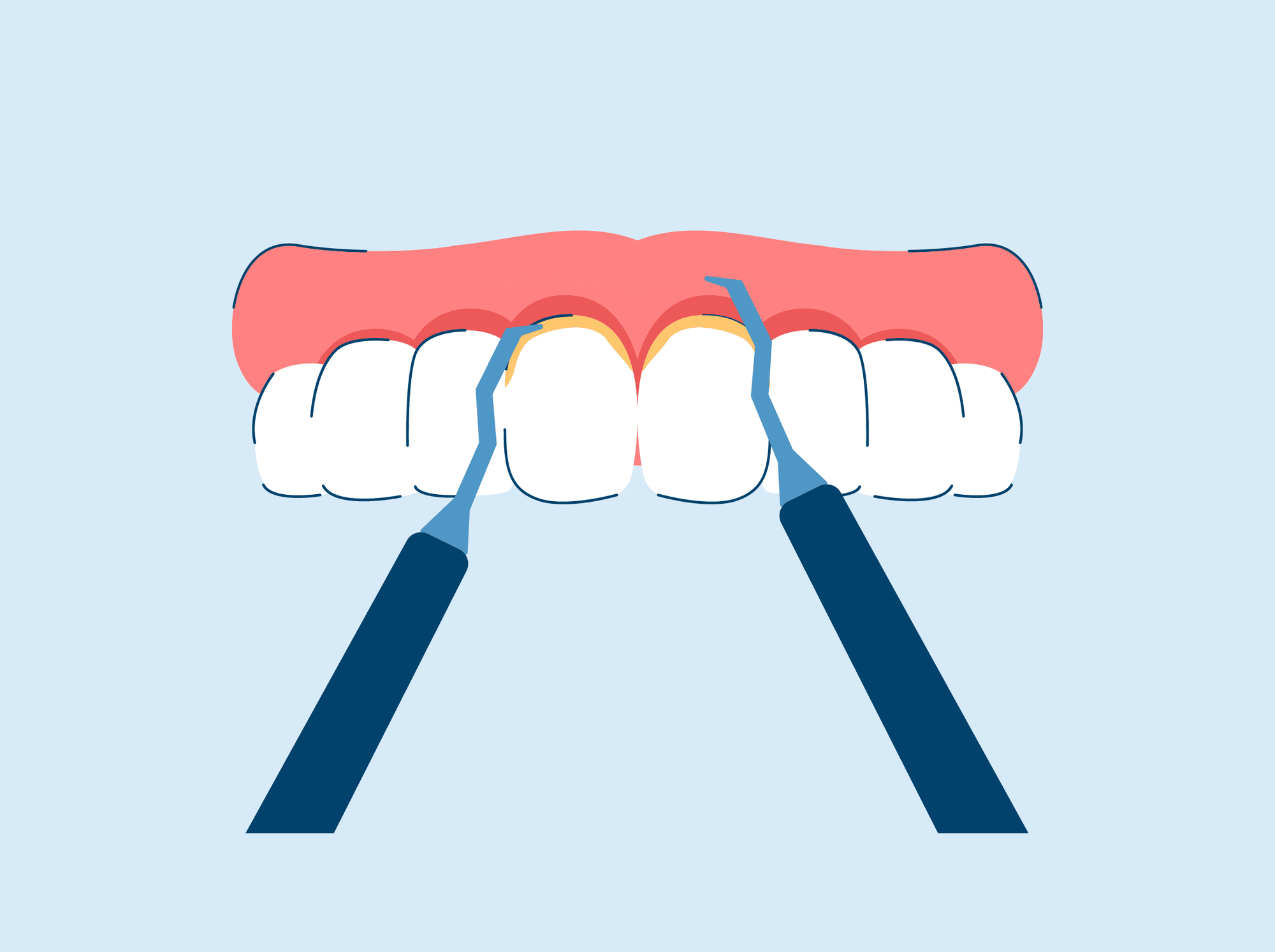 Scaling and Root Planing for Gum Disease