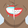 should i whiten my teeth before braces 