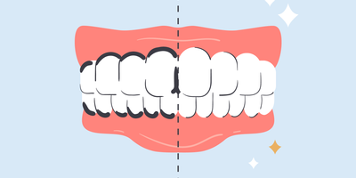 silver diamine fluoride stain removal from teeth 