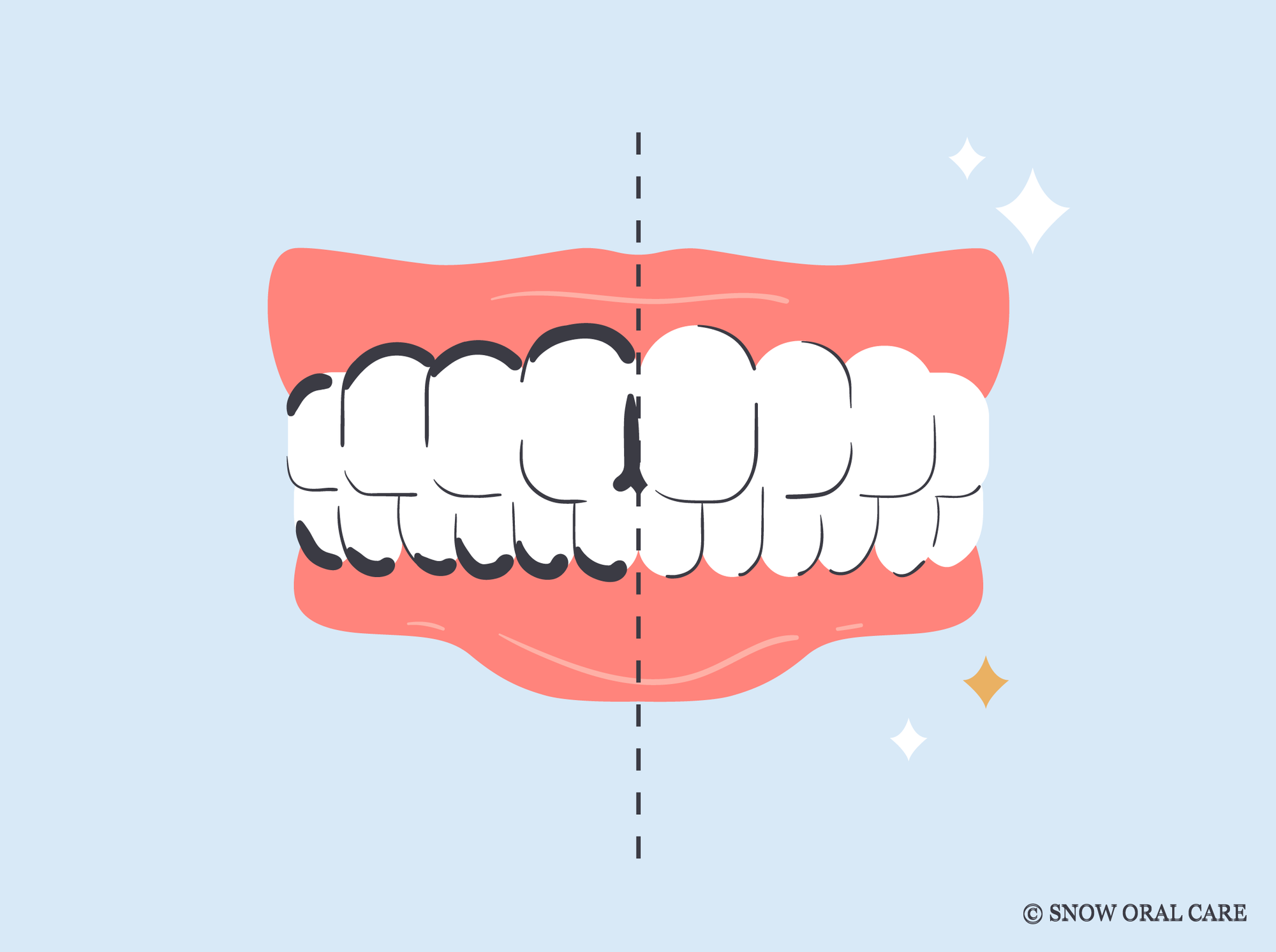 silver diamine fluoride stain removal from teeth 