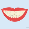 stained fillings front teeth