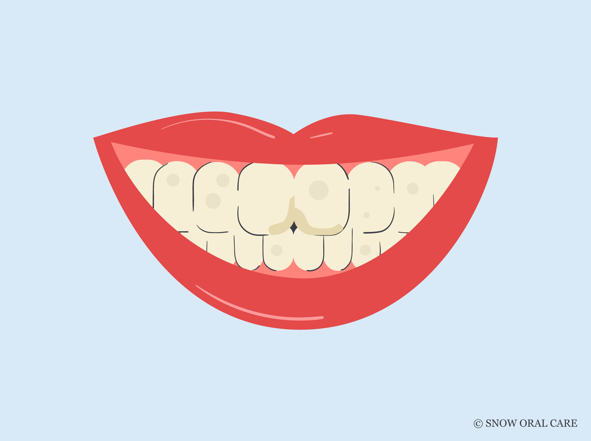 stained fillings front teeth