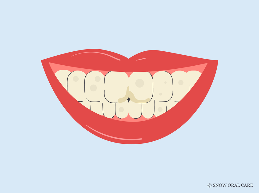 stained fillings front teeth