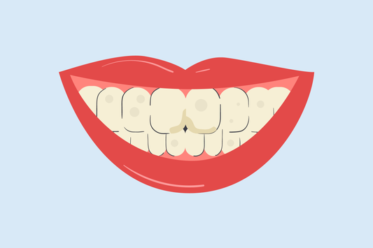 stained fillings front teeth