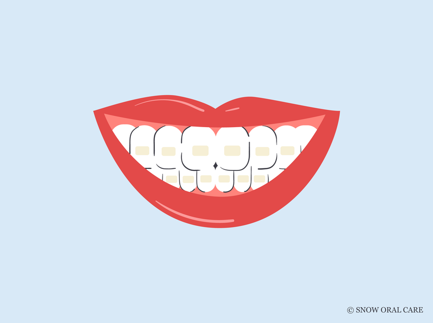stained teeth after braces 