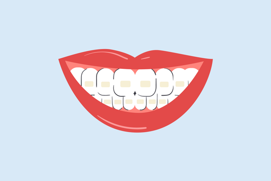 stained teeth after braces 