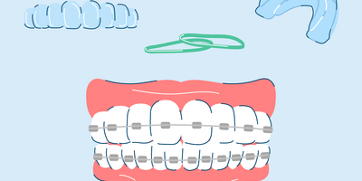 5 Teeth Straightening Options Compared and Explained