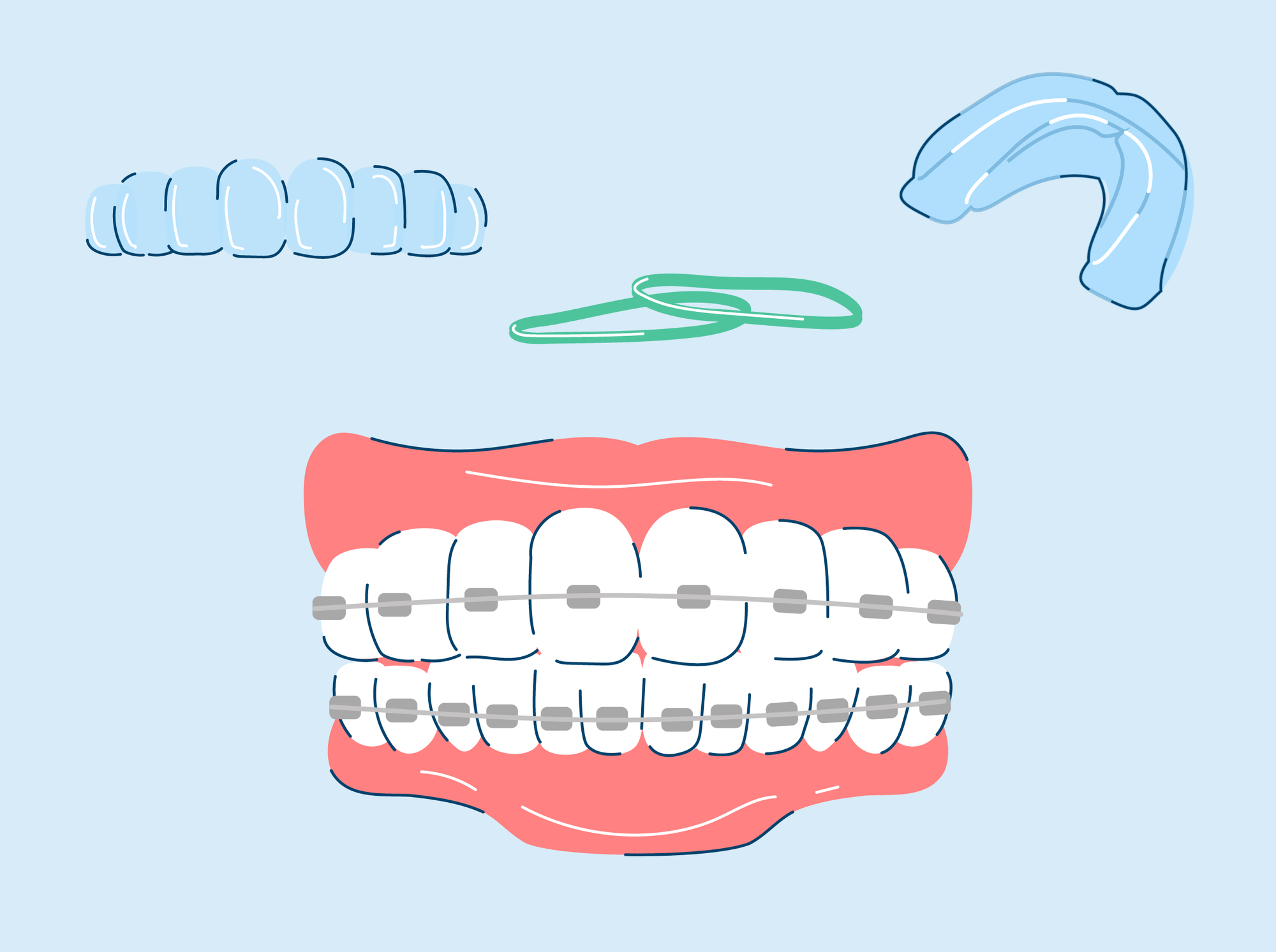 5 Teeth Straightening Options Compared and Explained