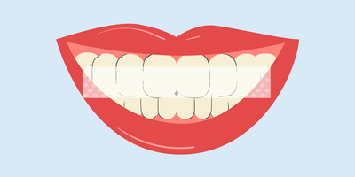 teeth still yellow after whitening 