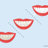 teeth whitening 