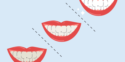 teeth whitening 