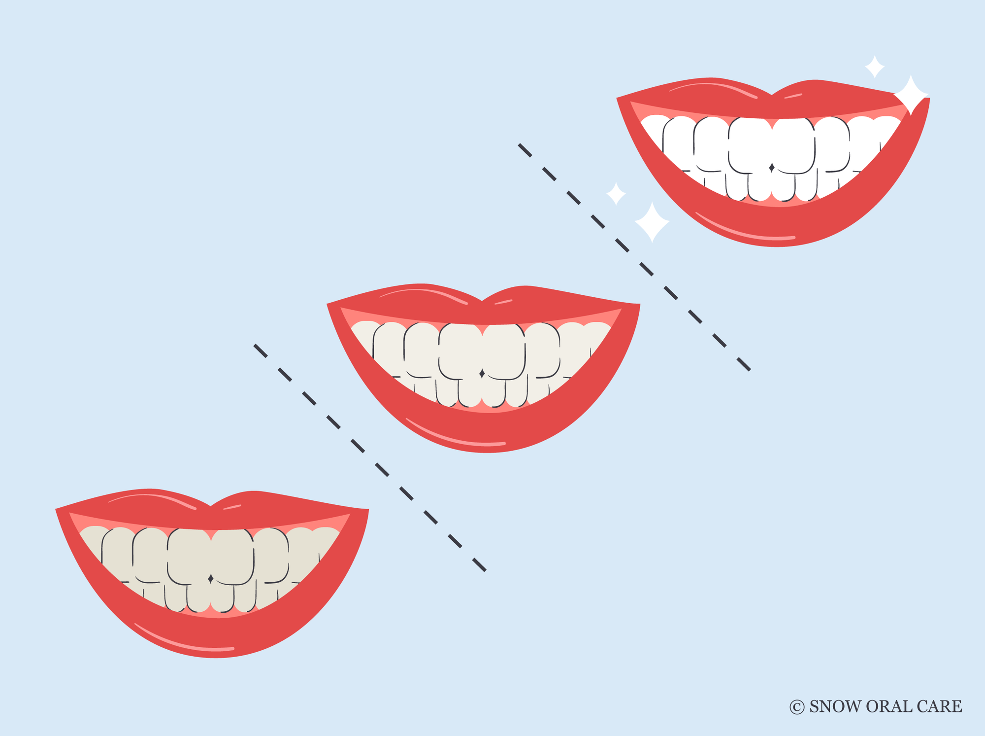 teeth whitening 
