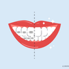 teeth whitening after braces 