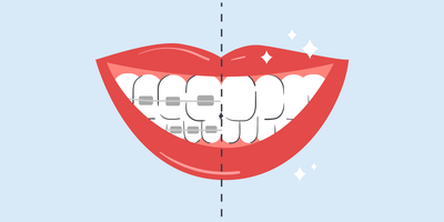 teeth whitening after braces 