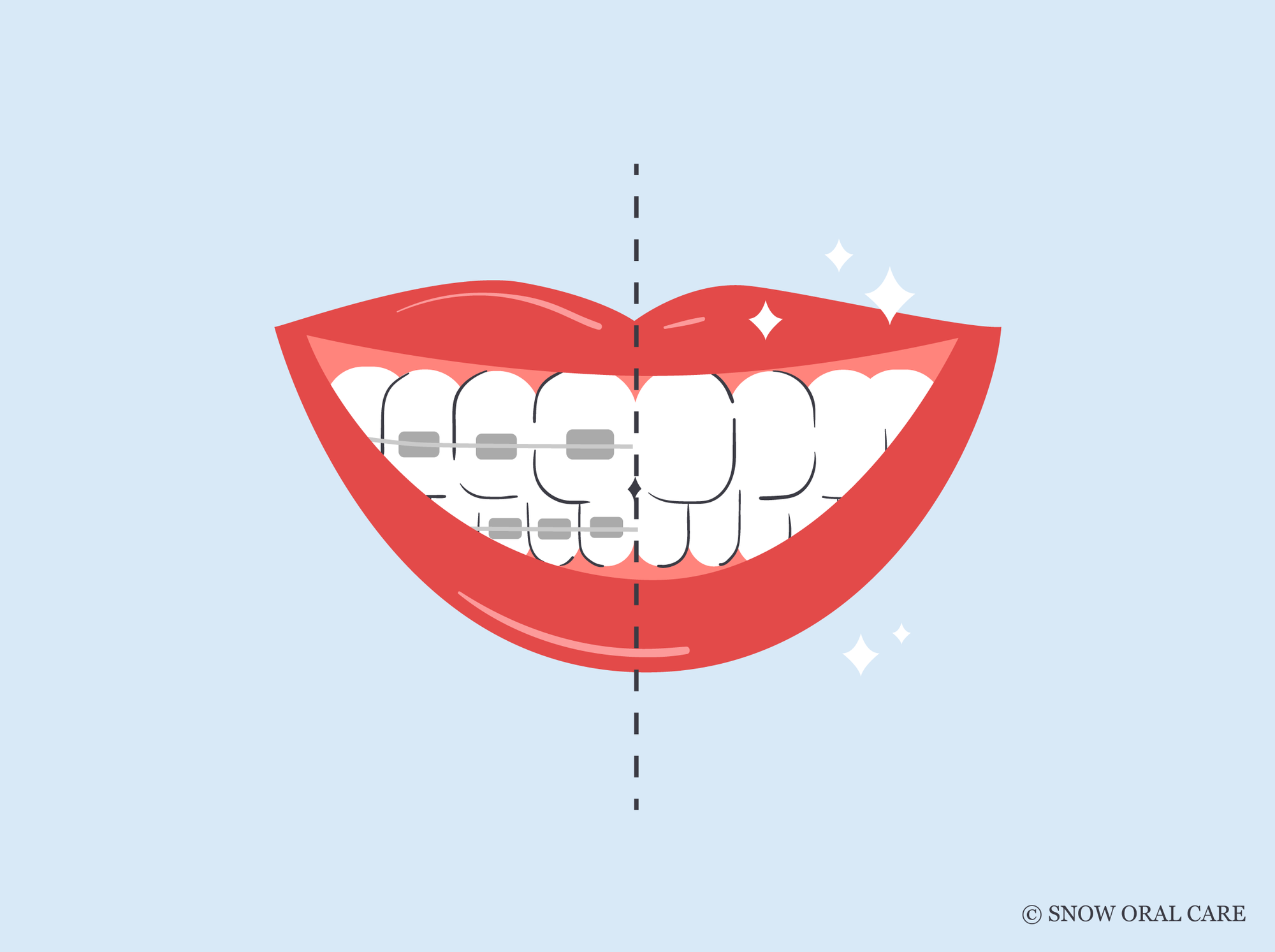 teeth whitening after braces 