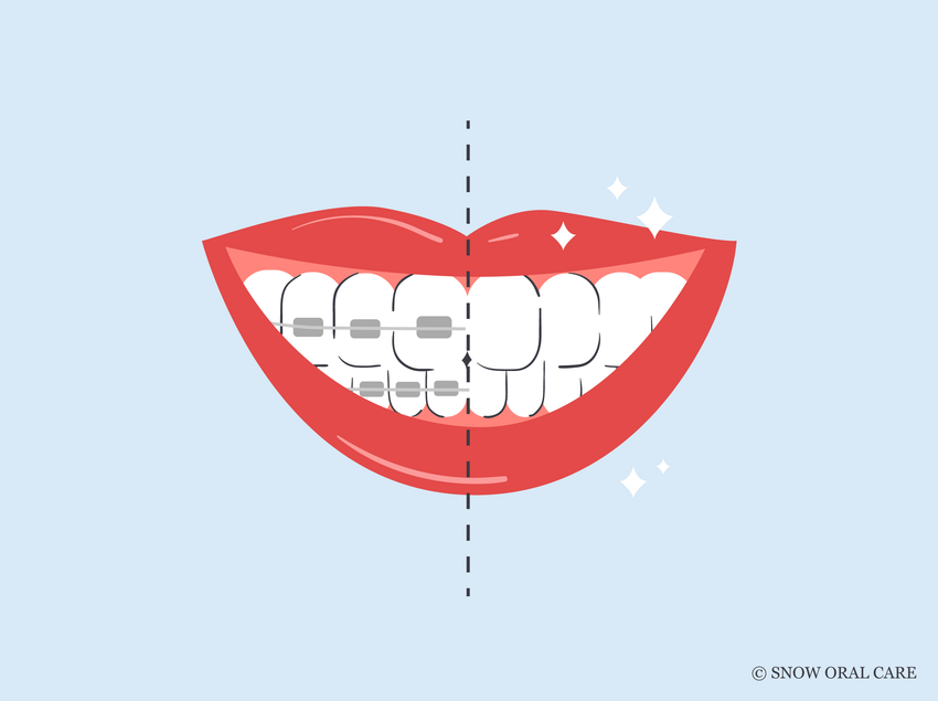 teeth whitening after braces 